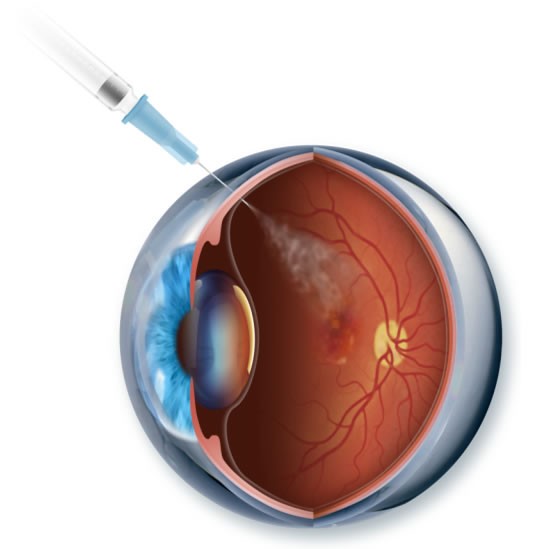 Centre for Sight to start Macular Degeneration treatments