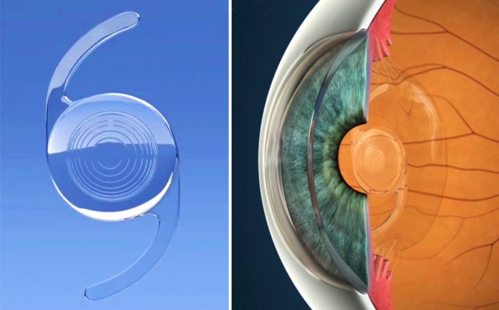 Laser Lens Exchange vs Laser Cataract Surgery Centre for