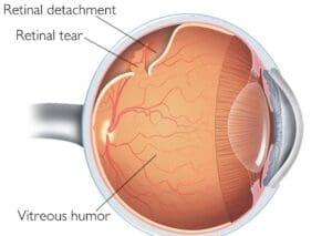 Centre for Sight - Retinal detachment - vitreous